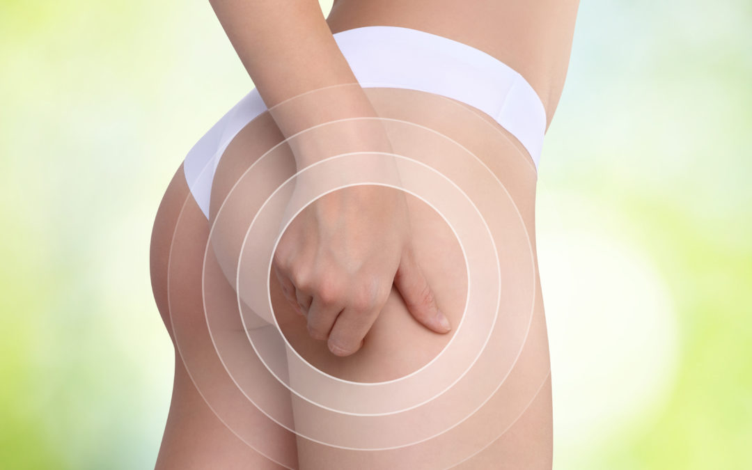 Eliminare la cellulite da cosce e glutei? Sì, si può!