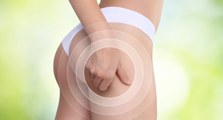 Eliminare cellulite dal sedere e dalle cosce