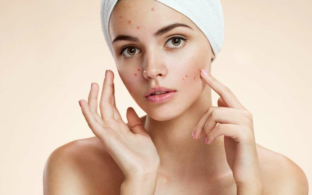 Pillola e acne: quello che devi sapere