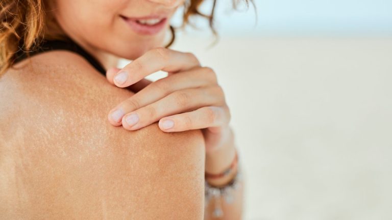 macchie solari in estate