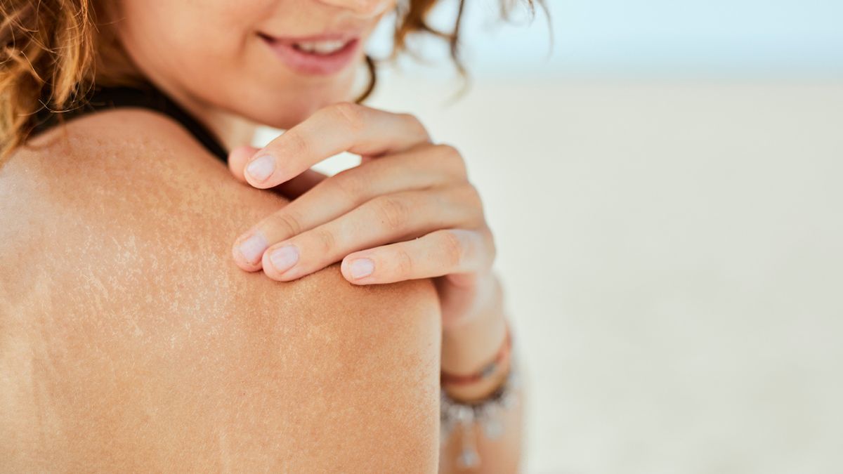 macchie solari in estate